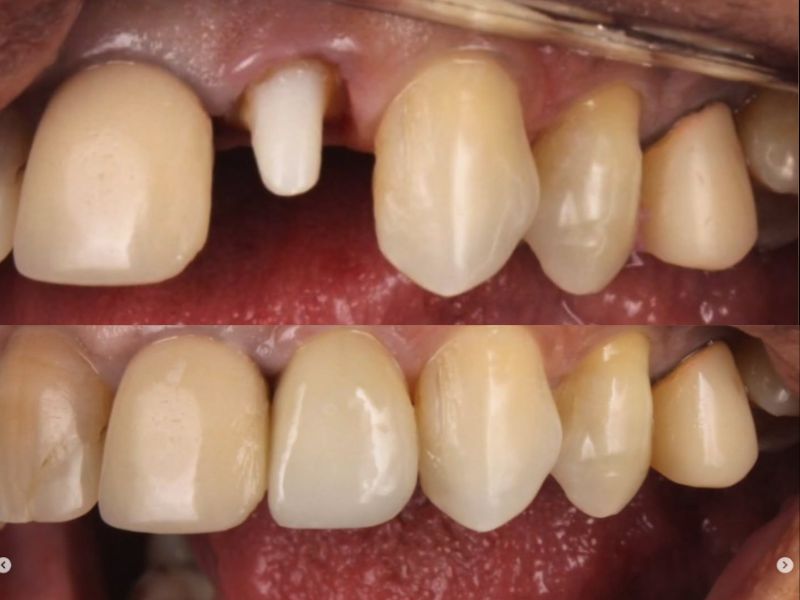 Caso 02 — antes e depois do tratamento